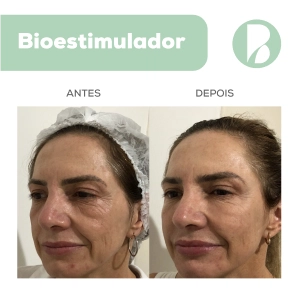 Bioestimulador - Exemplo 2