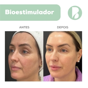 Bioestimulador - Exemplo 1